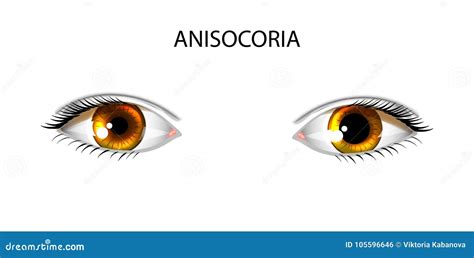 Anisocoria Pupils Of Different Sizes Stock Vector Illustration Of