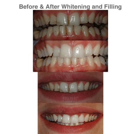 White Teeth And White Fillings Pma Dental Care Dentist Gravesend Kent