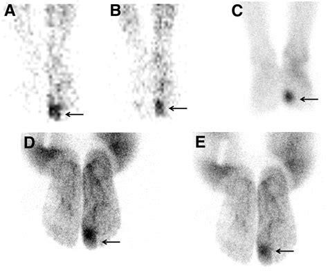 The Diagnostic Value Of 99mtc Igg Scintigraphy In The Diabetic Foot And