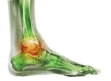Osteoarthritis Of The Ankle Photograph By Dr P Marazziscience Photo