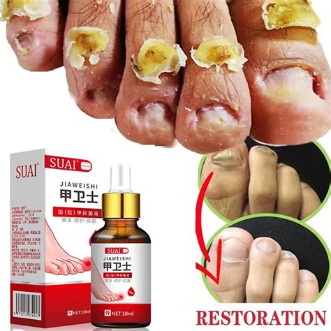 Nail Fungal Treatment Serum Onychomycosis Paronychia Anti Infection Toe Fungus Hand Foot Removal