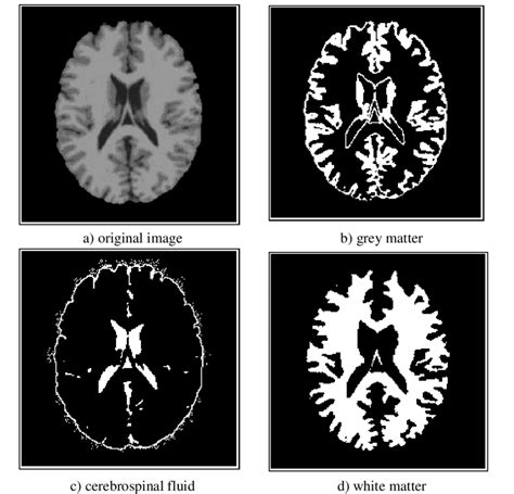 Pfcm Segmentation Of An Mri Brain Image Download Scientific Diagram