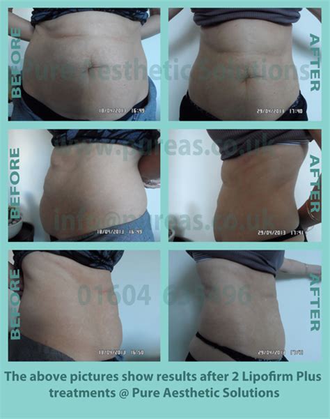 Ultrasonic Liposuction Before After Results Northampton