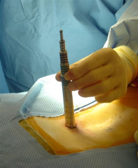 Minimally Invasive Surgery Sardar Spine Top Spinal Disorders Surgeon