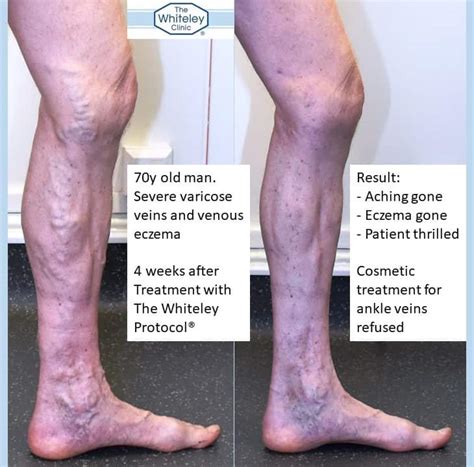 Varicose Eczema Cured By Whiteley Protocol The Whiteley Clinic