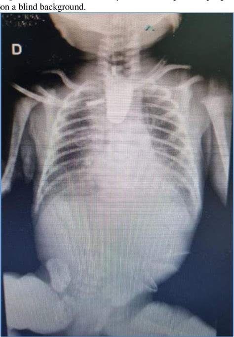 Figure 1 From Esophagus Atresia Without Tracheoesophageal Fistula A