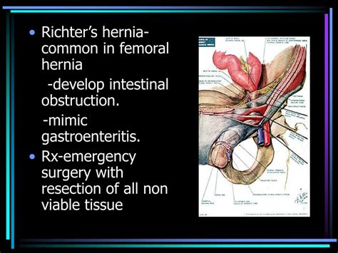 Ppt Femoral Hernia And Sliding Hernia Powerpoint Presentation Id All In One Photos