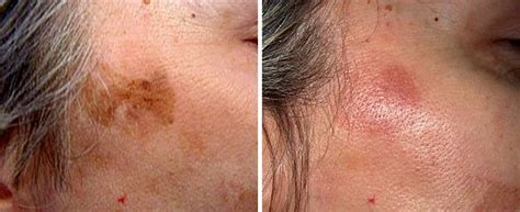 Best Treatment For Actinic Keratosis Dorothee Padraig South West Skin