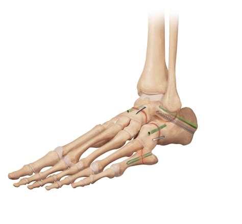 Arthrex Triple Arthrodesis