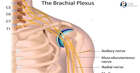 Brachial Plexus Surgery