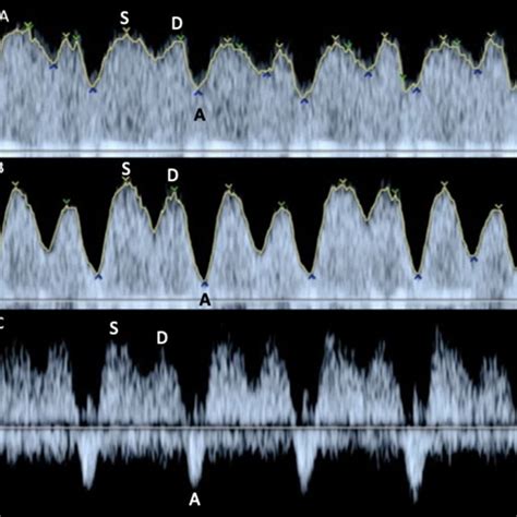 The Normal Umbilical Artery Doppler Waveform Is Characterized By