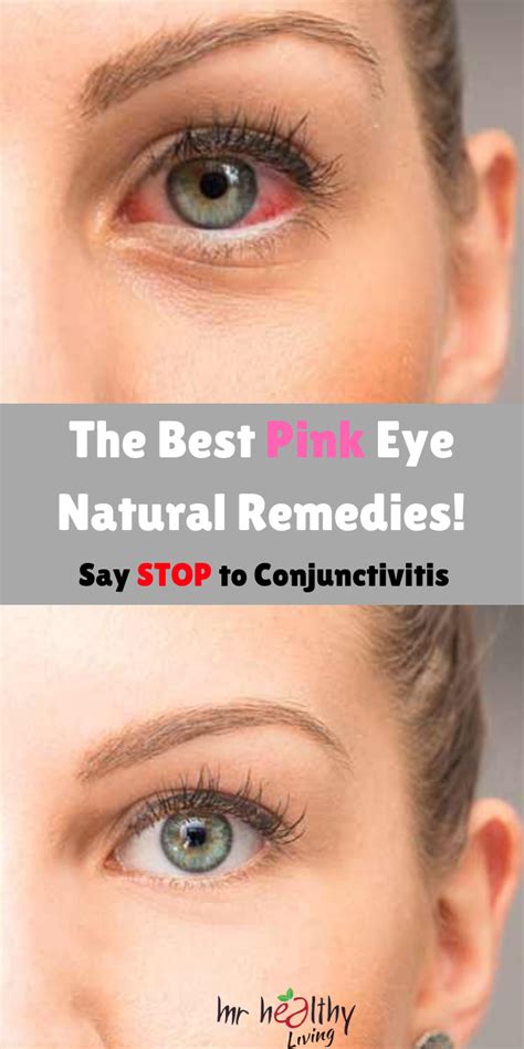 Get Rid Of The Pink Eye With These Homemade Remedies Pink Eye Remedy