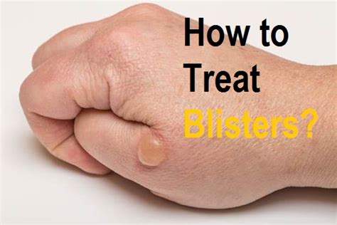 How To Treat Blisters