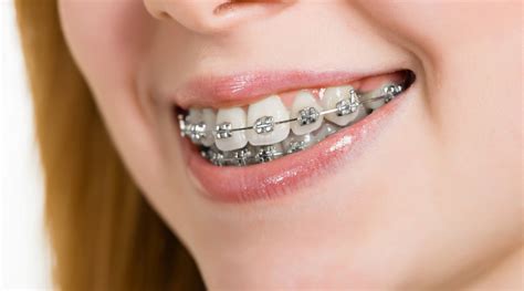 ¿cómo Se Ponen Los Brackets En Ortodoncia Paso A Paso Estudi Dental