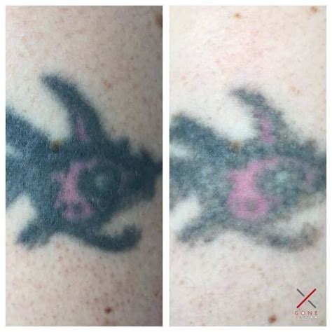 Before And After Of A Clients First Session Completely Healed
