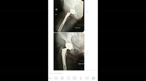 Just A Week Out No Therapy Total Hip Replacement Direct Superior