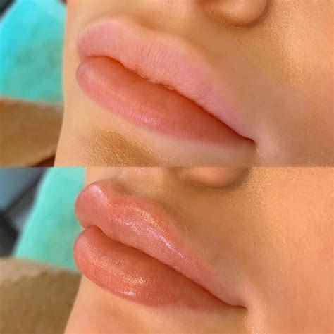 Preenchimento labial guia completo sobre como aumentar os lábios