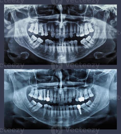 Ortopantomografía Imagen Panorámica Radiografía De Dientes 9280755 Foto