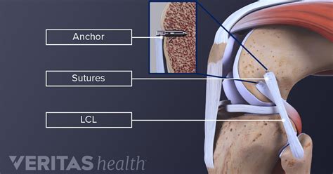 Surgical Treatment For Lcl Lateral Collateral Ligament Tears