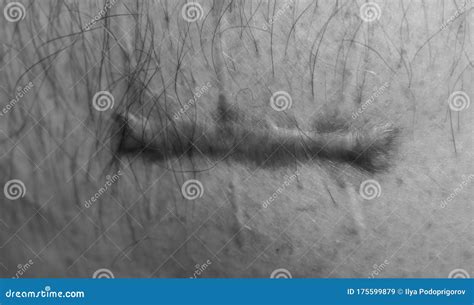 A Wounded On The Human Body Suture Protracted Old Deep Cut Scar