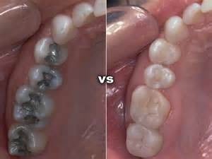 Fillings ? Amalgam vs Composite Louisville Dentist