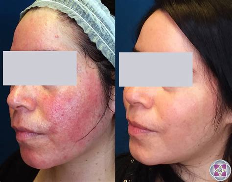 Laser Treatment For Rosacea How It Works
