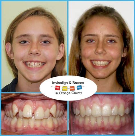 Before And After Patients Cases│invisalign And Braces In Orange County