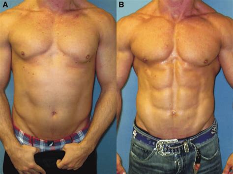 Images Before A And After B Gynecomastia Surgery In A Bodybuilder