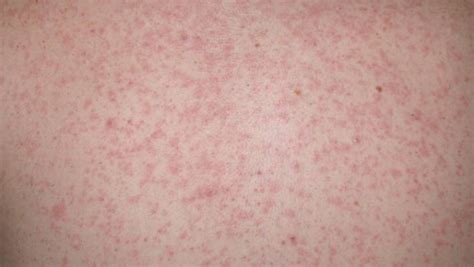 Measles Warning For Auckland After Person Ignores Quarantine Nz