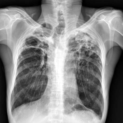 Tuberculosis X Ray Chest Xray Image Pa View Show Pulmonary