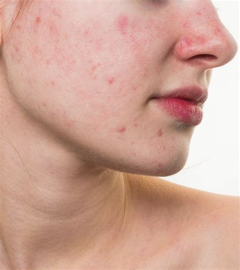 papier Tumeur maligne Compétitif red spots on face A gagné tempérer