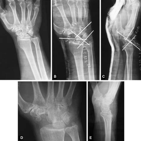 Anteroposterior Radiograph Of The Left Dominant Wrist Of A