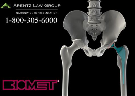 Biomet Hip Lawyers