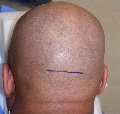 Or Snapshots Scalp Incision Location For Custom Occipital Skull