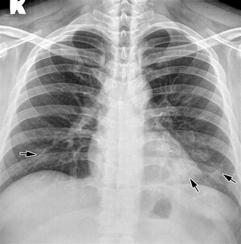 Chest X Ray Bronchitis Vs Pneumonia
