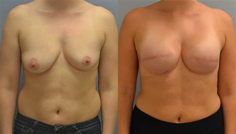 Breast Reconstruction Specialists In Plastic Surgery Pa