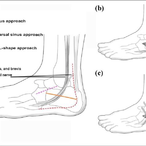 A Schematic Representation Of The Surgical Incision For Calcaneal