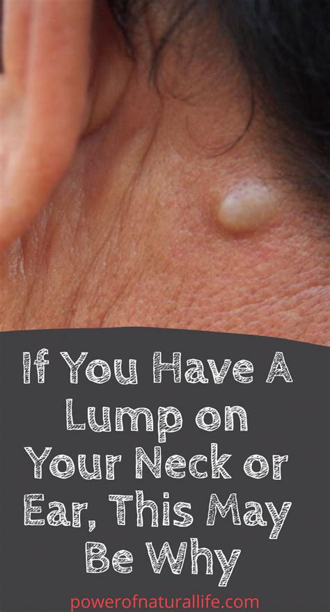 Do Youve A Lump On Your Neck Back Or Behind Your Ear That Is What