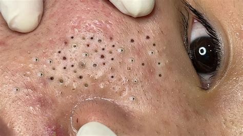 Treatment Blackheads And Acne Hidden Under The Eyes Youtube