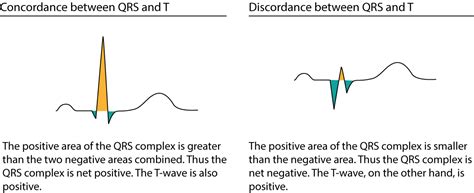 The T Wave Physiology Variants And Ecg Features Ekg And Echo