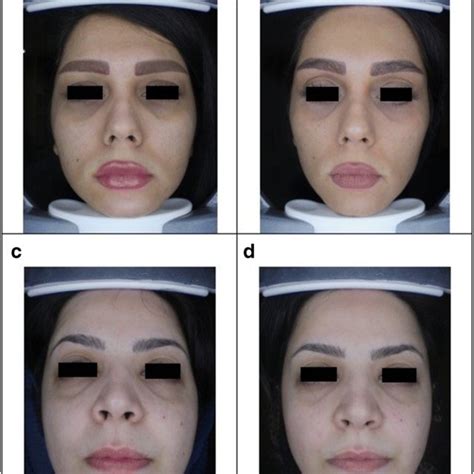 Comparison Of Carboxy Therapy And Fractional Q Switched Ndyag Laser On