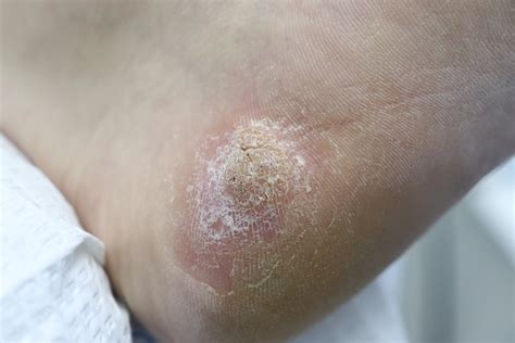 Plantar Warts Symptoms Causes And Treatment Options