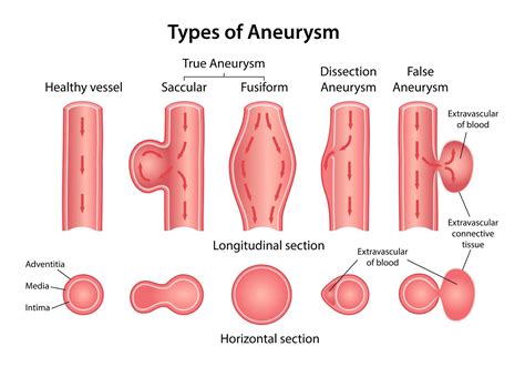 Everything You Need To Know About Brain Aneurysms Interventional