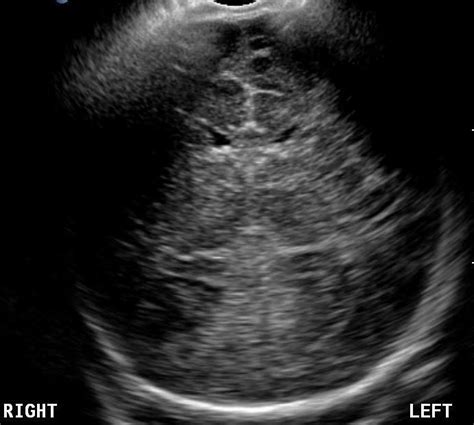 Neonatal Head Sutures Ultrasound