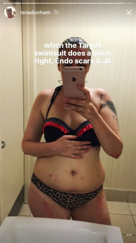 Lena Dunham Posted A Bikini Photo Showing Off Her Endometriosis Scars