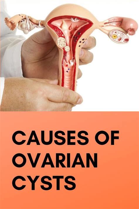 Causes Of Ovarian Cysts Health Experts Ovarian Cyst Ovarian Cysts