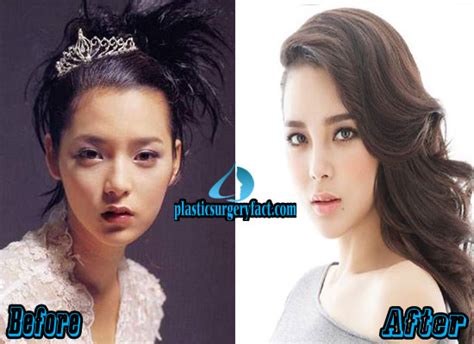 Park Si Yeon Plastic Surgery Before And After Pictures Plastic