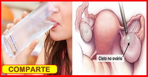 → Remedio Casero Para Quistes En El Ovario 【existe Y Funciona】