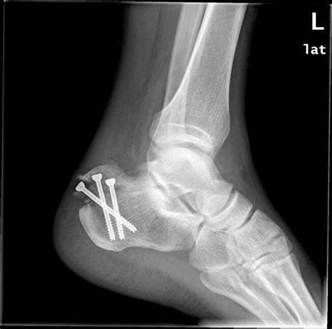 Lateral X Ray Of The Calcaneus The Avulsion Fracture Of The Calcaneal