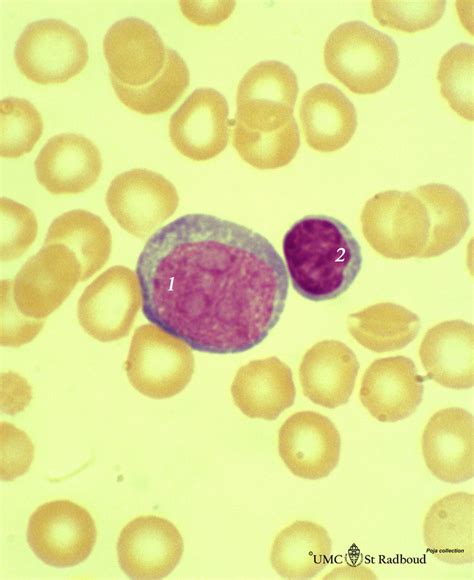 Myeloblast In Bone Marrow Smear Human Poja Collection Microscopic